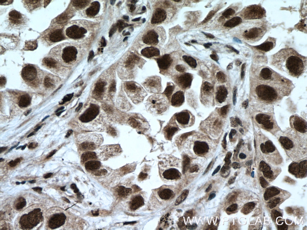 Immunohistochemistry (IHC) staining of human lung cancer tissue using LSM4 Polyclonal antibody (10834-1-AP)