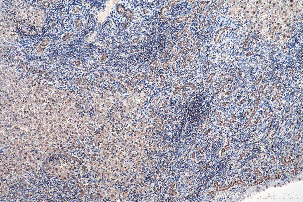 Immunohistochemistry (IHC) staining of human liver cancer tissue using LSM5 Polyclonal antibody (10700-1-AP)