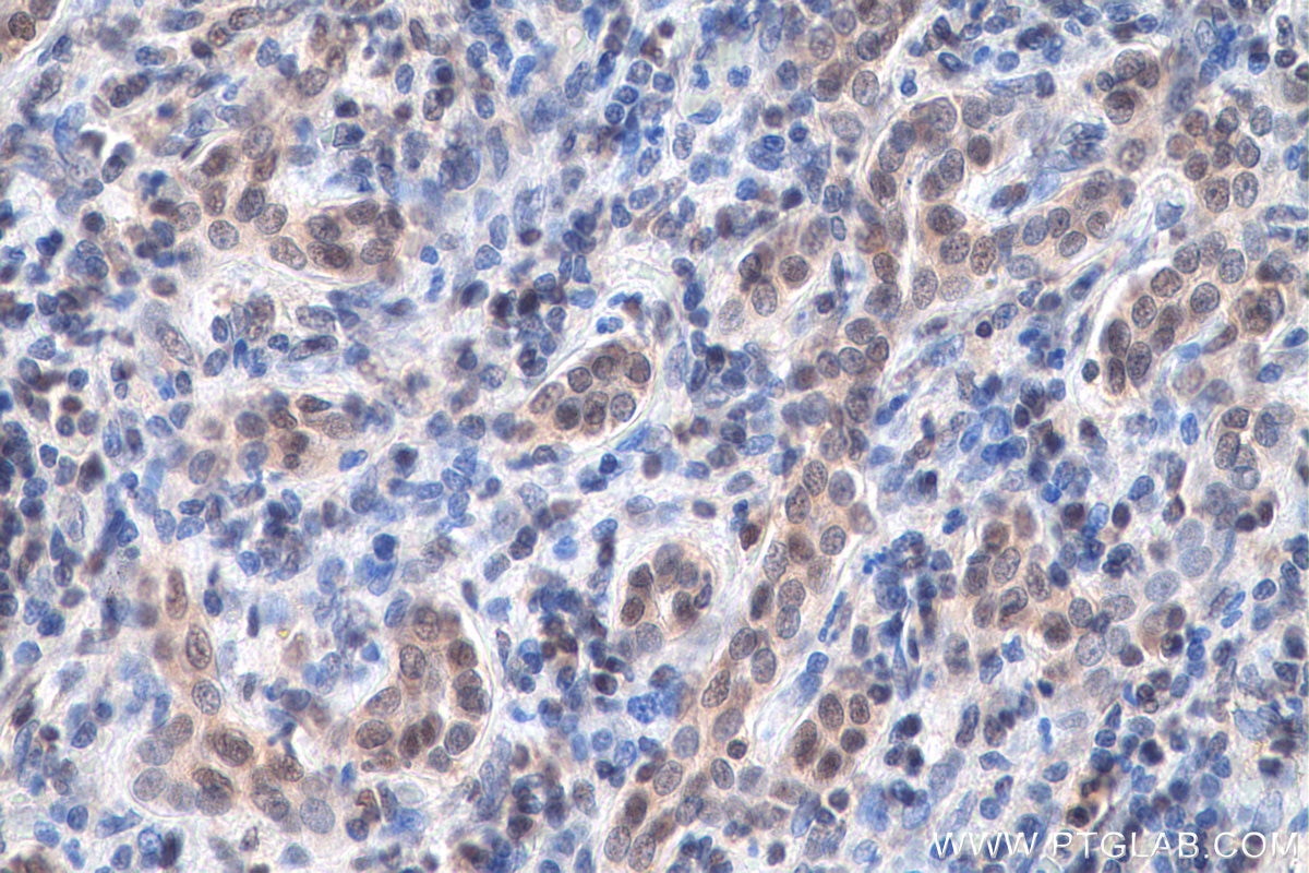 Immunohistochemistry (IHC) staining of human liver cancer tissue using LSM5 Polyclonal antibody (10700-1-AP)
