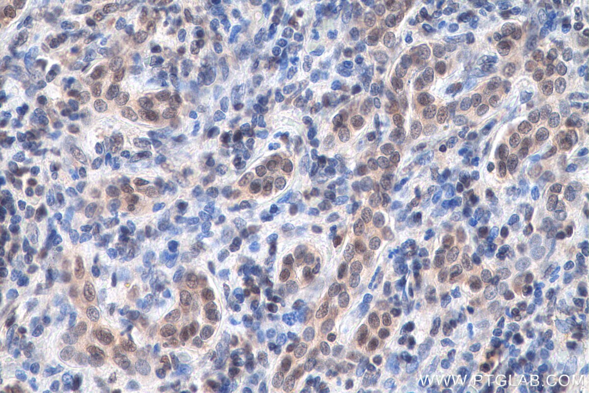 Immunohistochemistry (IHC) staining of human liver cancer tissue using LSM5 Polyclonal antibody (10700-1-AP)