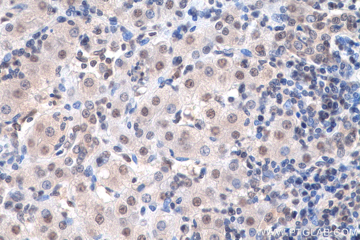 Immunohistochemistry (IHC) staining of human liver cancer tissue using LSM5 Polyclonal antibody (10700-1-AP)