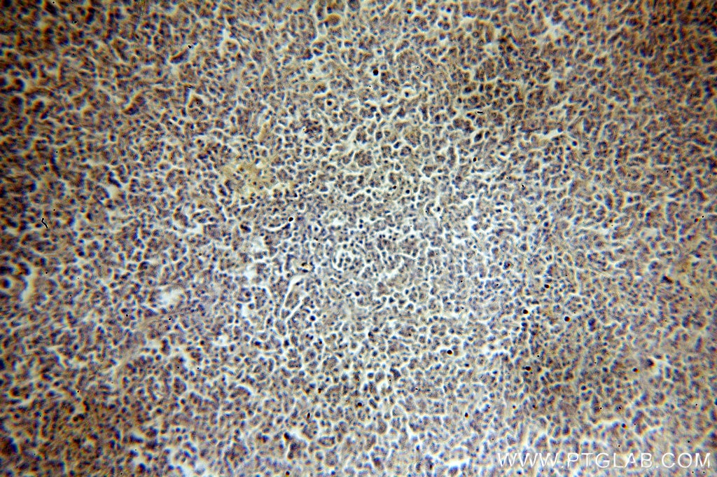 Immunohistochemistry (IHC) staining of human lymphoma tissue using LSM7 Polyclonal antibody (18941-1-AP)