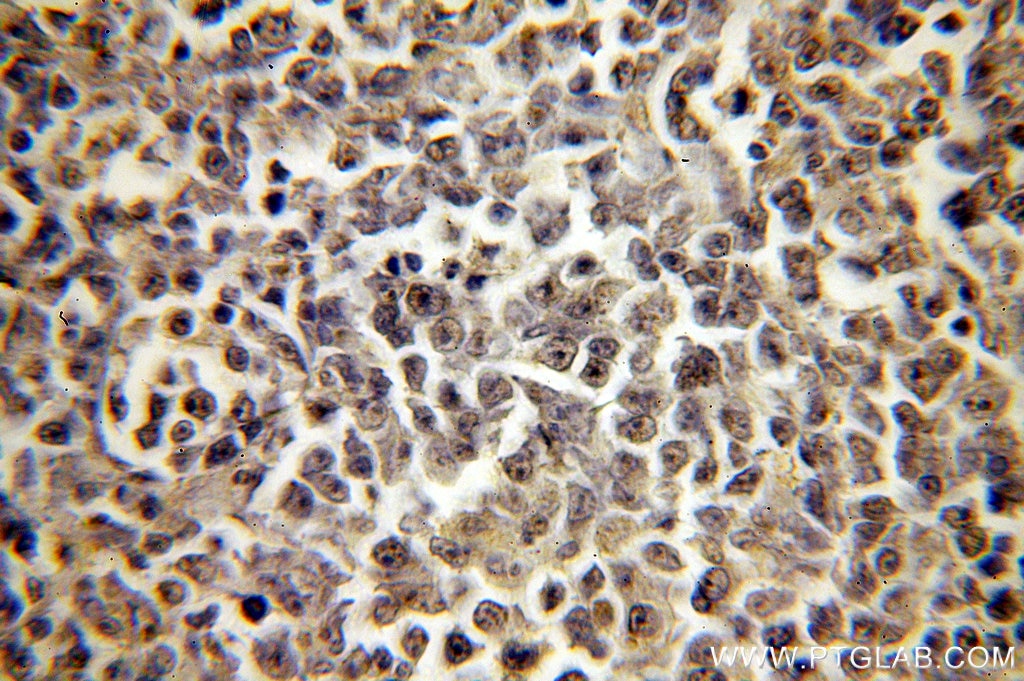 IHC staining of human lymphoma using 18941-1-AP