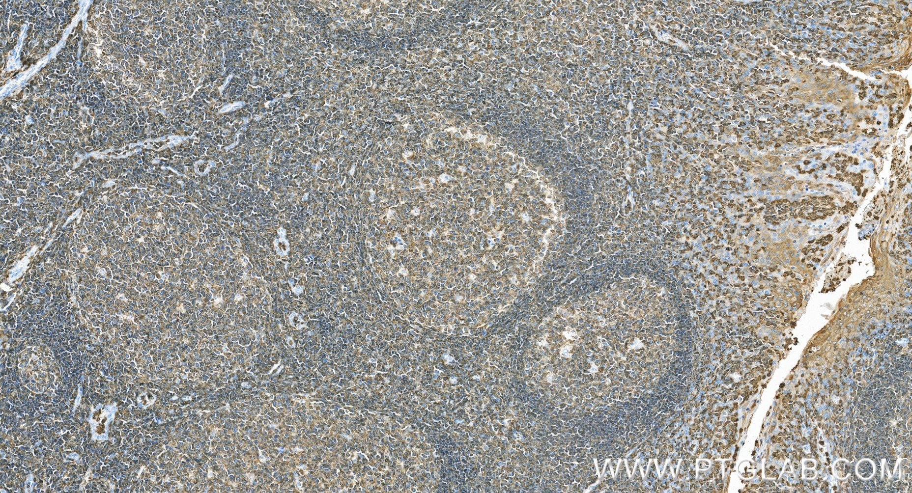 IHC staining of human tonsillitis using 87378-1-RR Immunohistochemistry (IHC) staining of human tonsillitis tissue using LSP1 Recombinant monoclonal antibody (87378-1-RR)