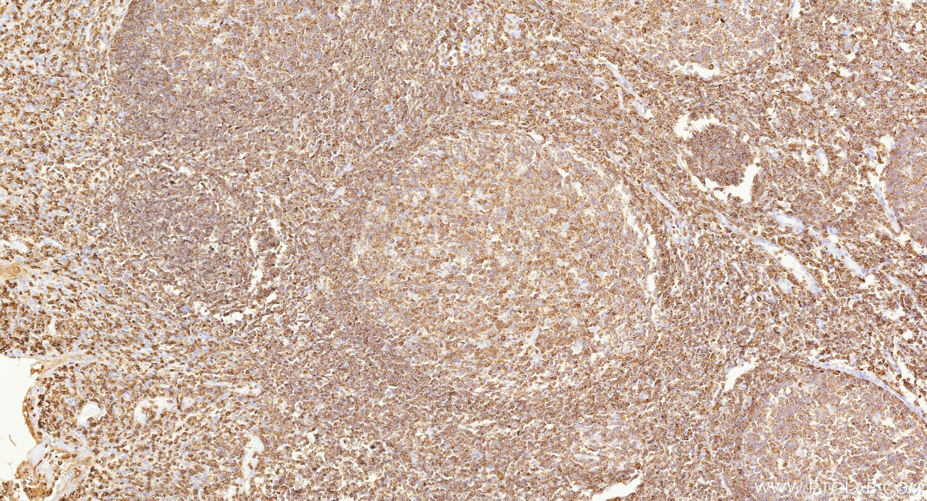 IHC staining of human tonsillitis using Biotin-87378 Immunohistochemistry (IHC) staining of human tonsillitis tissue using Biotin-conjugated LSP1 Recombinant monoclonal anti (Biotin-87378)