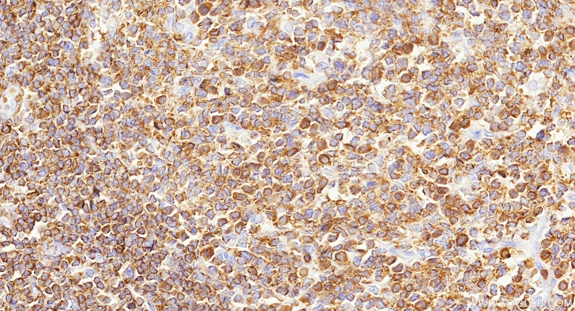 IHC staining of human tonsillitis using Biotin-87378 Immunohistochemistry (IHC) staining of human tonsillitis tissue using Biotin-conjugated LSP1 Recombinant monoclonal anti (Biotin-87378)