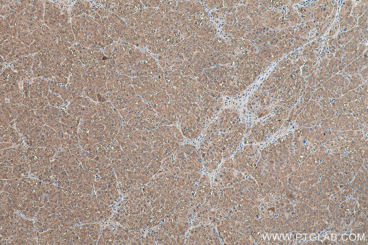 Immunohistochemistry (IHC) staining of human liver cancer tissue using LSS Polyclonal antibody (18693-1-AP)