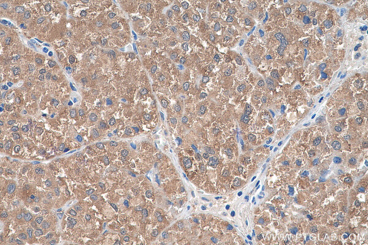 Immunohistochemistry (IHC) staining of human liver cancer tissue using LSS Polyclonal antibody (18693-1-AP)