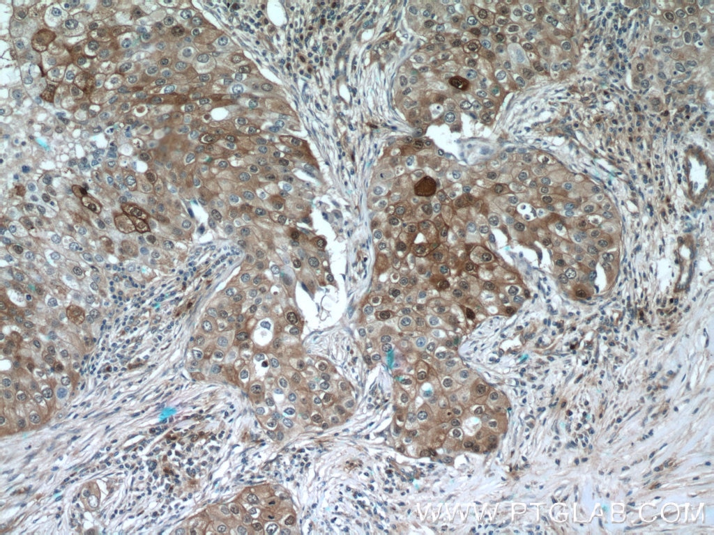 Immunohistochemistry (IHC) staining of human breast cancer tissue using LTB4R Polyclonal antibody (55137-1-AP)