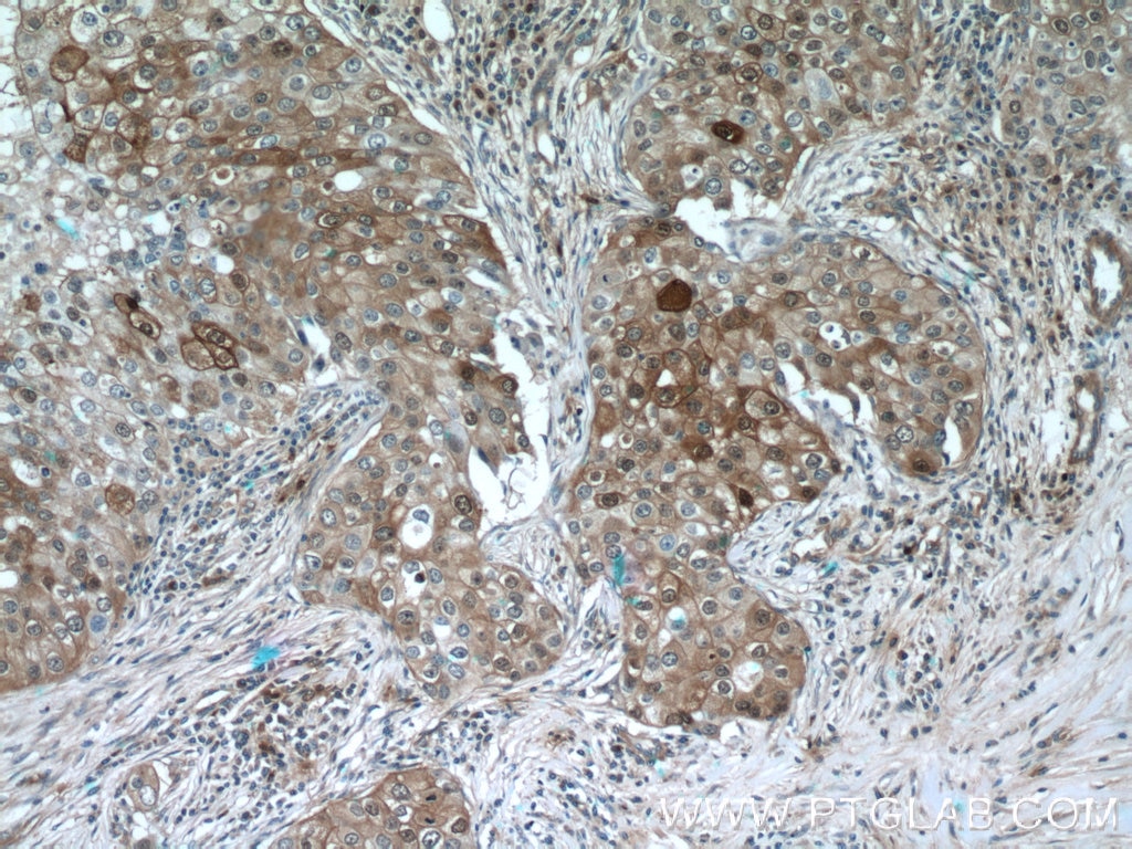 Immunohistochemistry (IHC) staining of human breast cancer tissue using LTB4R Polyclonal antibody (55137-1-AP)