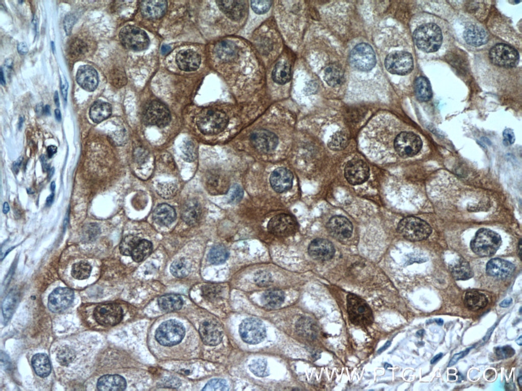 Immunohistochemistry (IHC) staining of human breast cancer tissue using LTB4R Polyclonal antibody (55137-1-AP)