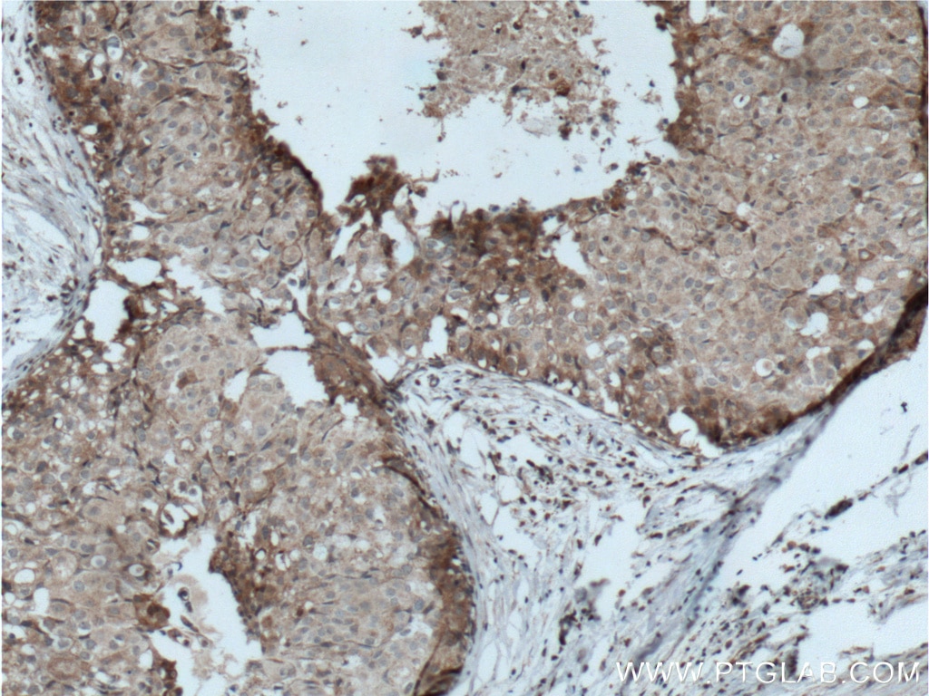 Immunohistochemistry (IHC) staining of human breast cancer tissue using LTBP1 Polyclonal antibody (22065-1-AP)