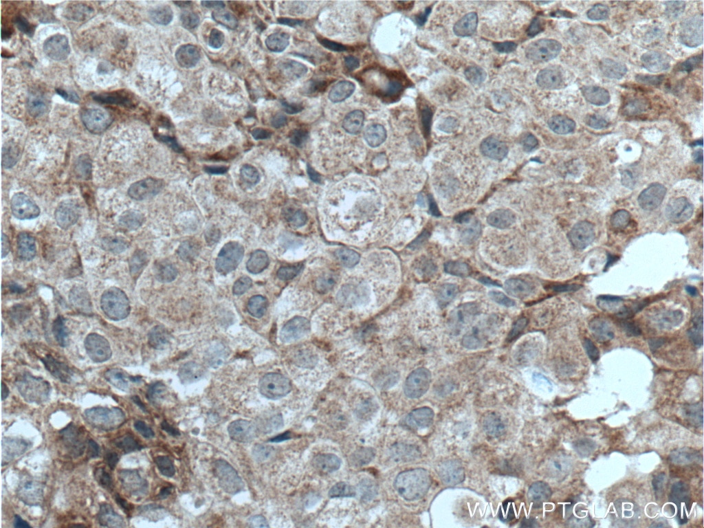 Immunohistochemistry (IHC) staining of human breast cancer tissue using LTBP1 Polyclonal antibody (22065-1-AP)