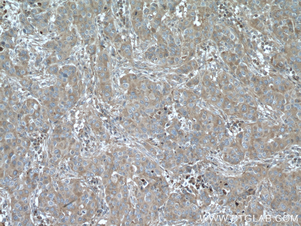 Immunohistochemistry (IHC) staining of human breast cancer tissue using LTBP1 Polyclonal antibody (26855-1-AP)