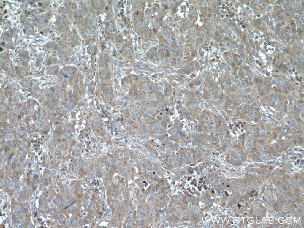 Immunohistochemistry (IHC) staining of human breast cancer tissue using LTBP1 Polyclonal antibody (26855-1-AP)