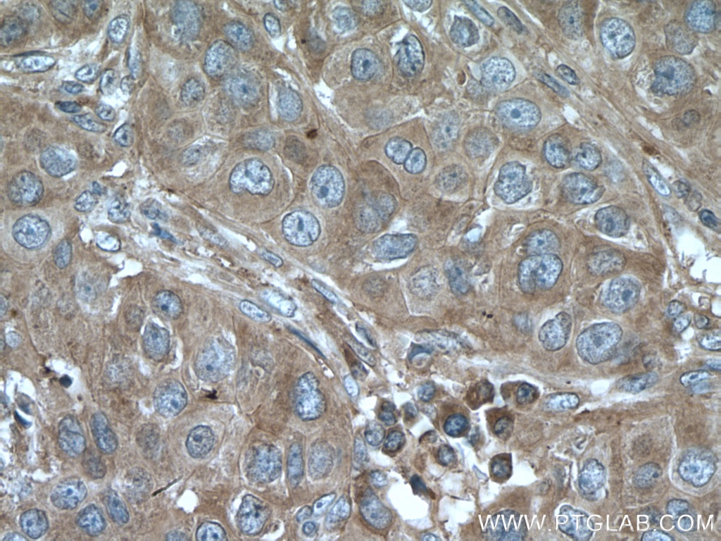 Immunohistochemistry (IHC) staining of human breast cancer tissue using LTBP1 Polyclonal antibody (26855-1-AP)