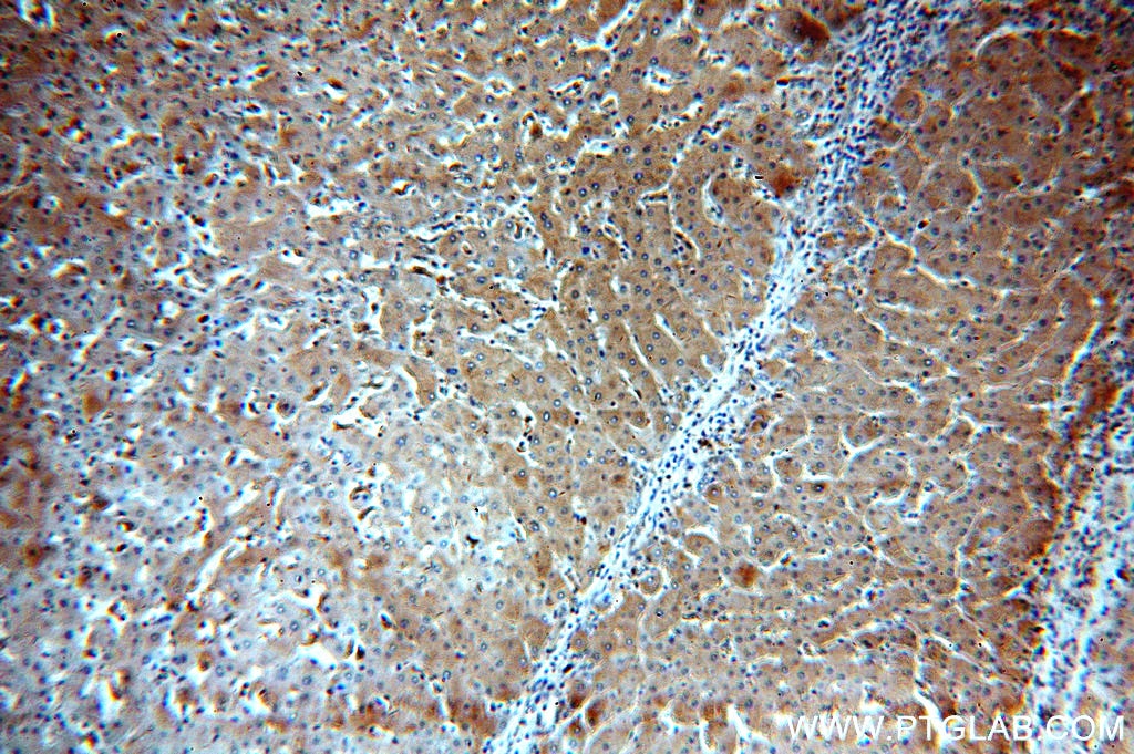 Immunohistochemistry (IHC) staining of human hepatocirrhosis tissue using LTBR Polyclonal antibody (20331-1-AP)