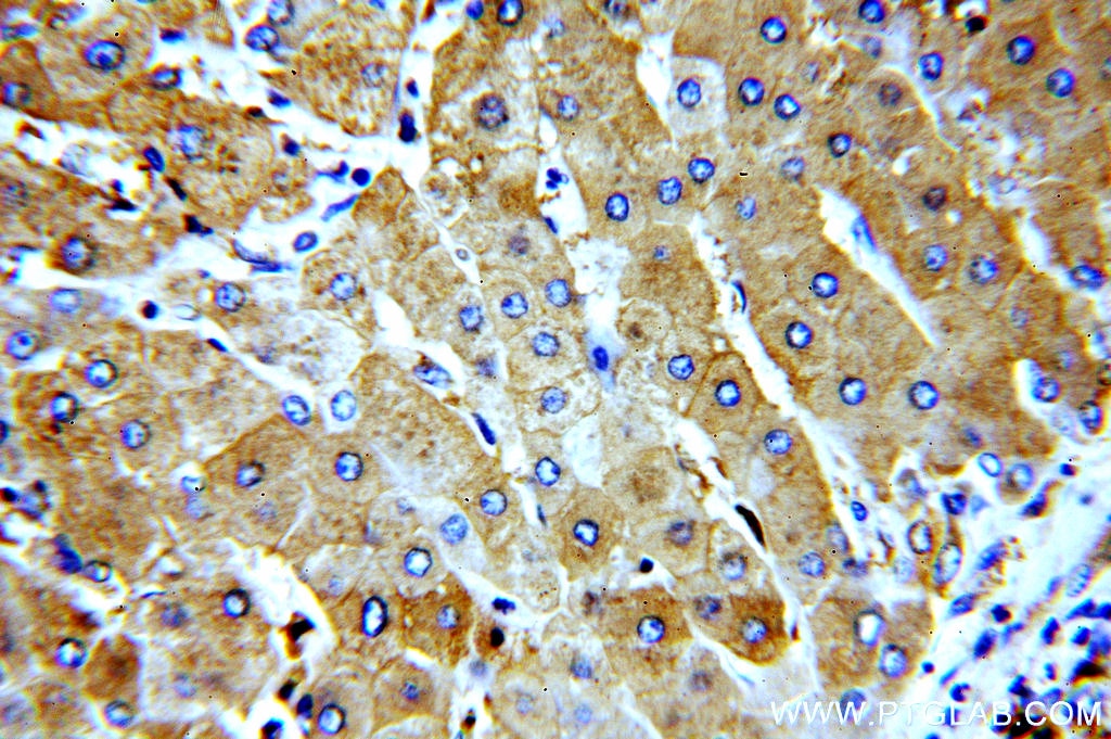 IHC staining of human hepatocirrhosis using 20331-1-AP