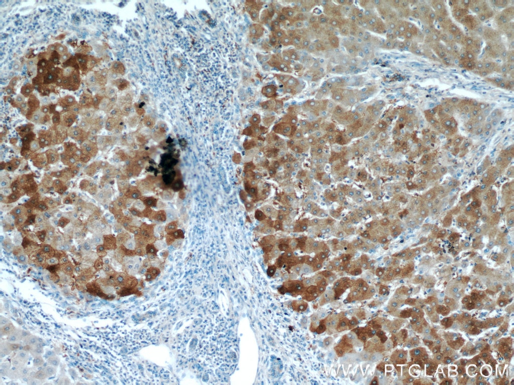 Immunohistochemistry (IHC) staining of human hepatocirrhosis tissue using LTBR Polyclonal antibody (20331-1-AP)