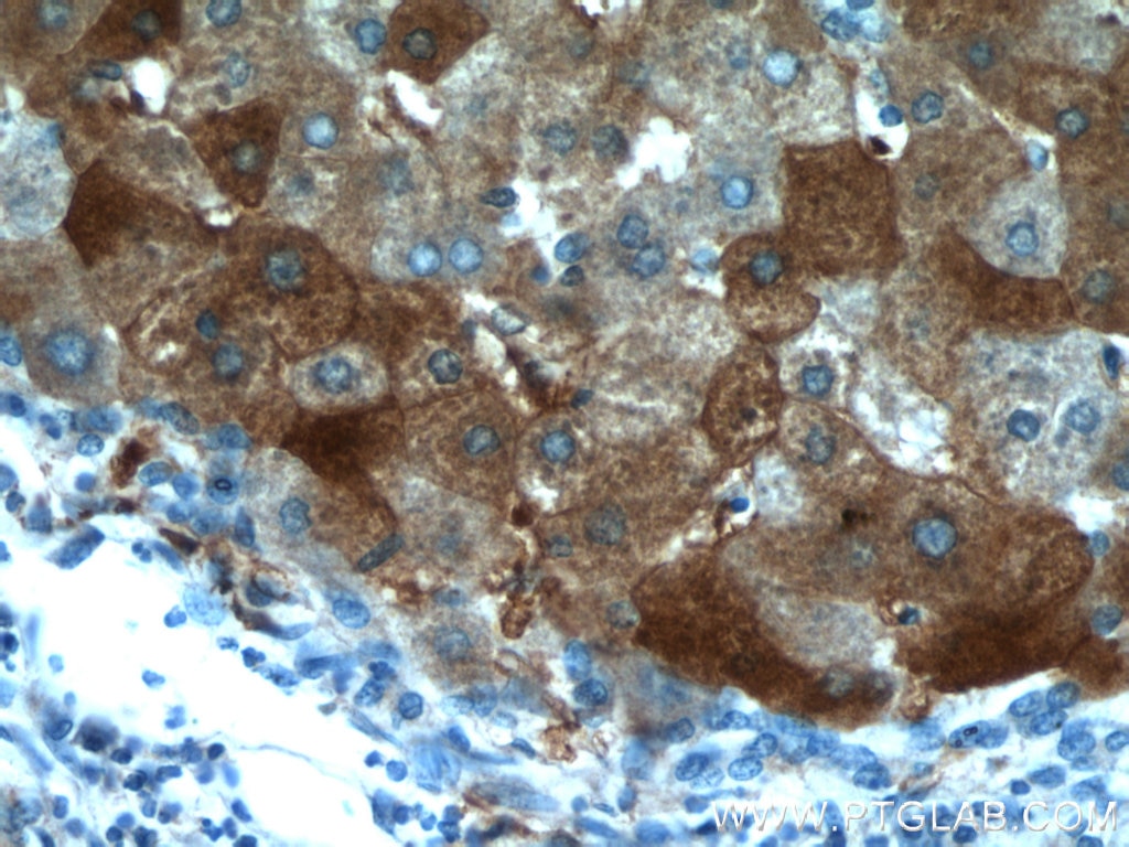 Immunohistochemistry (IHC) staining of human hepatocirrhosis tissue using LTBR Polyclonal antibody (20331-1-AP)