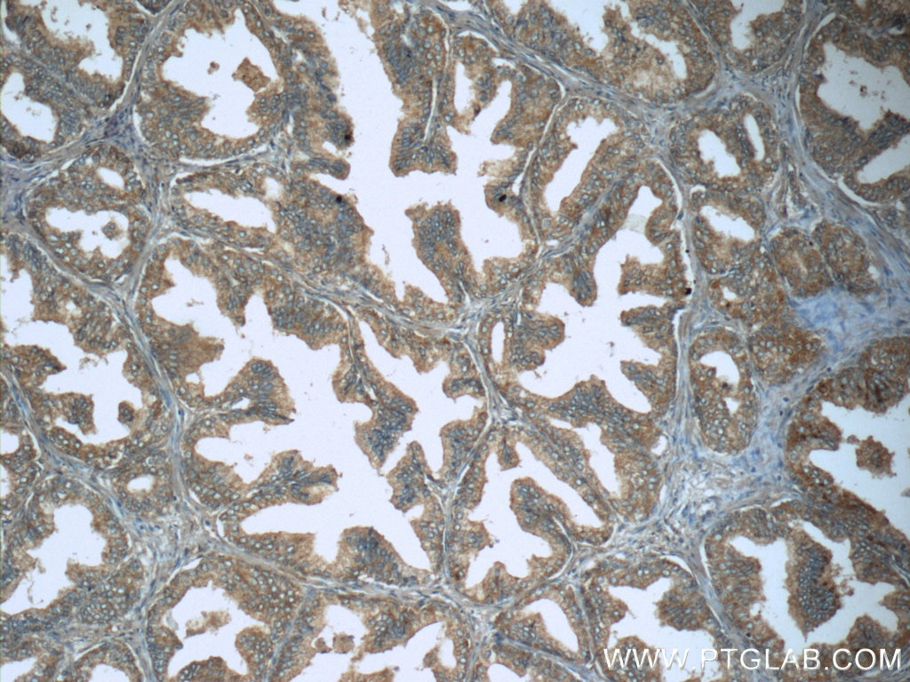 Immunohistochemistry (IHC) staining of human prostate hyperplasia tissue using LTF Polyclonal antibody (10933-1-AP)