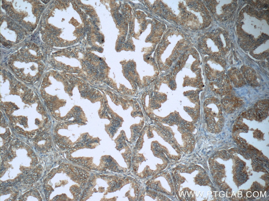 IHC staining of human prostate hyperplasia using 10933-1-AP