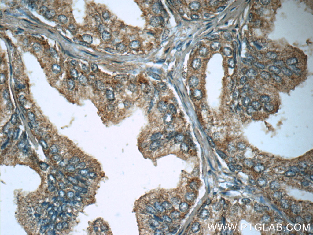 Immunohistochemistry (IHC) staining of human prostate hyperplasia tissue using LTF Polyclonal antibody (10933-1-AP)