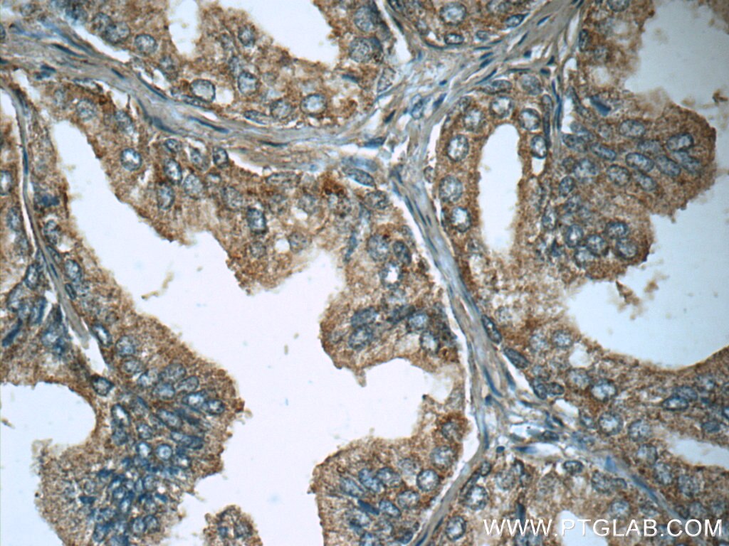 IHC staining of human prostate hyperplasia using 10933-1-AP