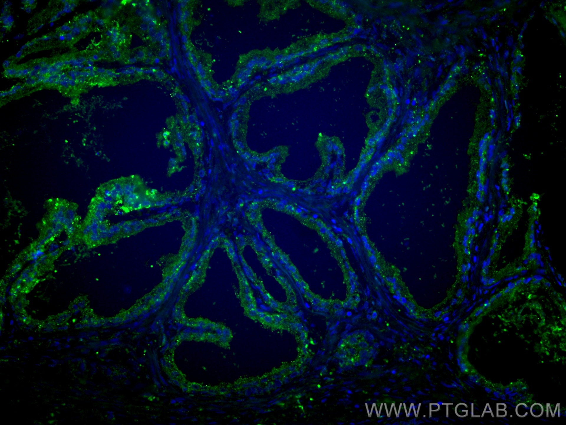 Immunofluorescence (IF) / fluorescent staining of human prostate cancer tissue using LY6D Polyclonal antibody (17361-1-AP)