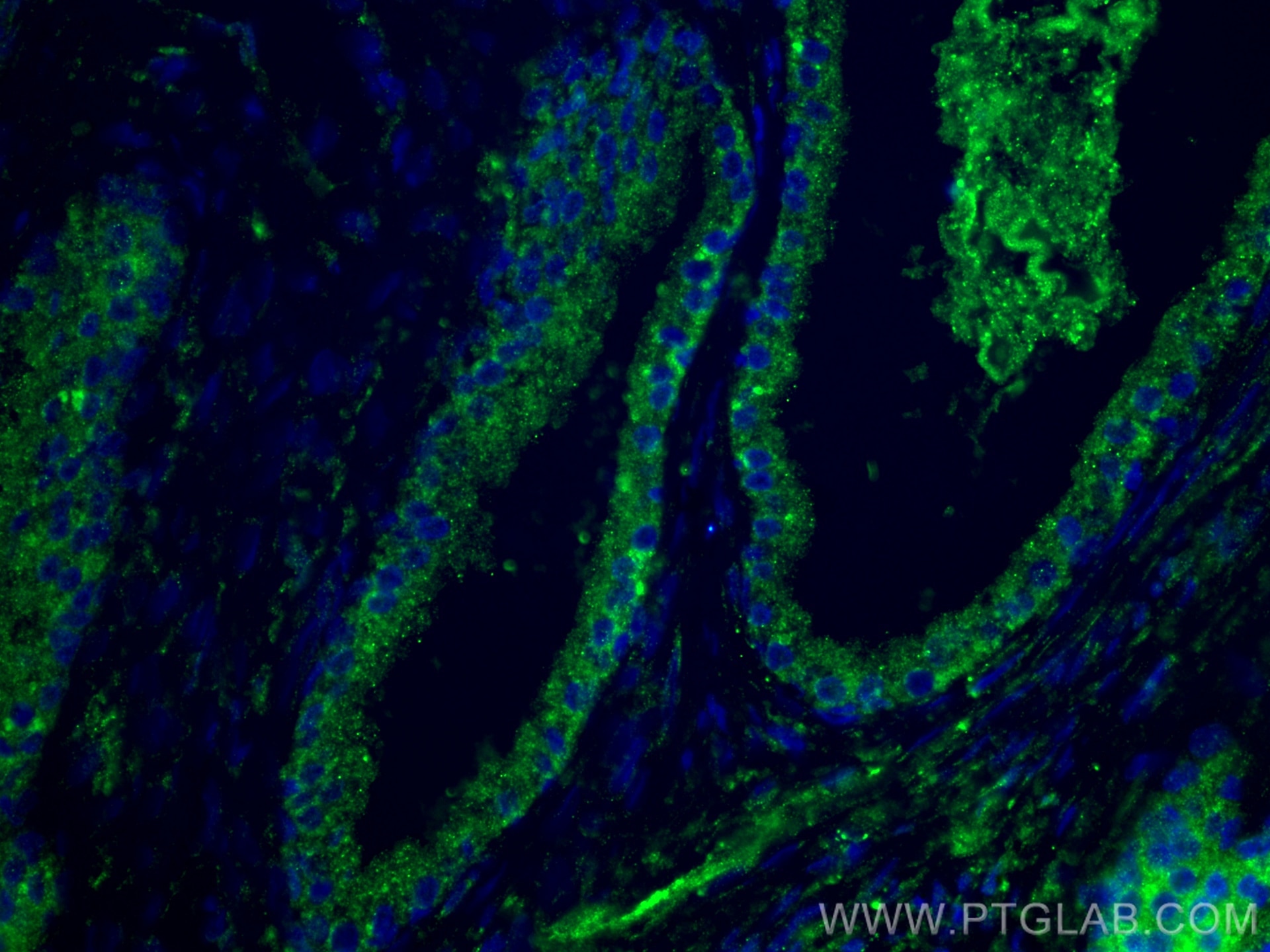 Immunofluorescence (IF) / fluorescent staining of human prostate cancer tissue using LY6D Polyclonal antibody (17361-1-AP)