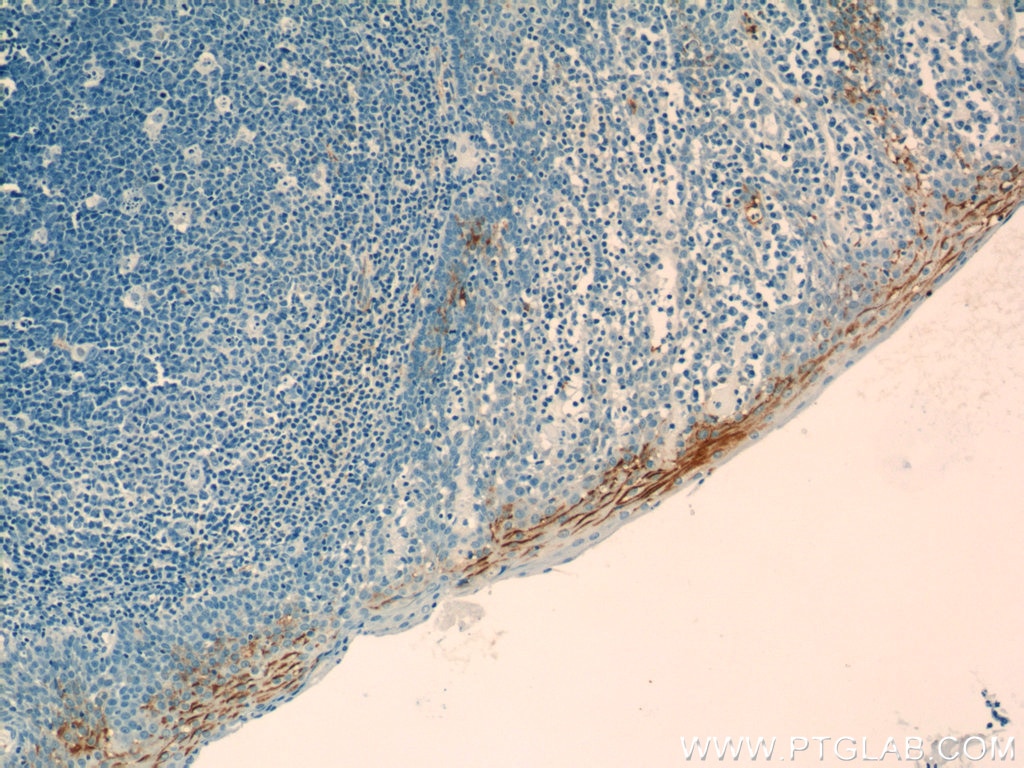 Immunohistochemistry (IHC) staining of human tonsillitis tissue using LY6D Polyclonal antibody (17361-1-AP)