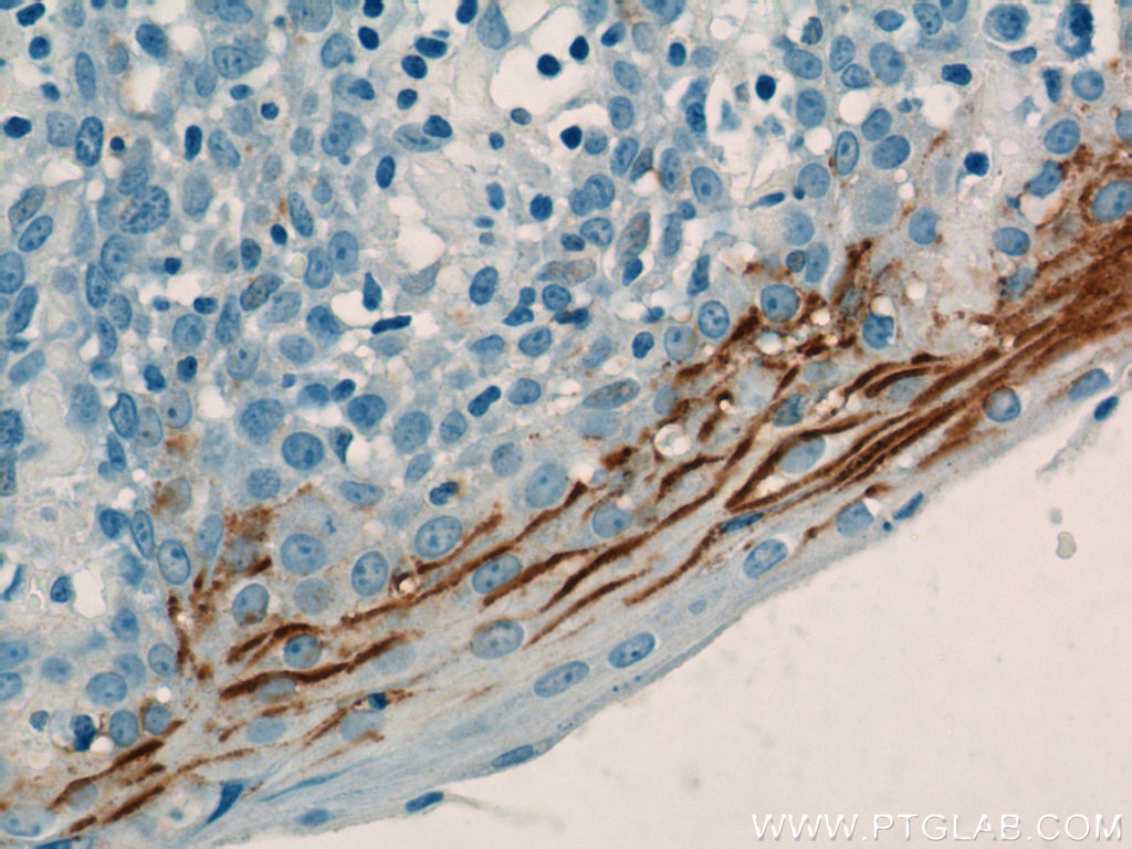 Immunohistochemistry (IHC) staining of human tonsillitis tissue using LY6D Polyclonal antibody (17361-1-AP)