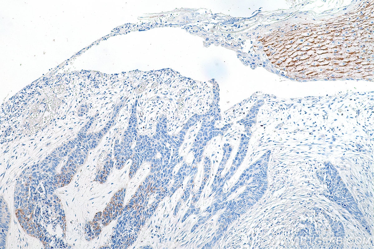 Immunohistochemistry (IHC) staining of human skin cancer tissue using LY6D Polyclonal antibody (17361-1-AP)