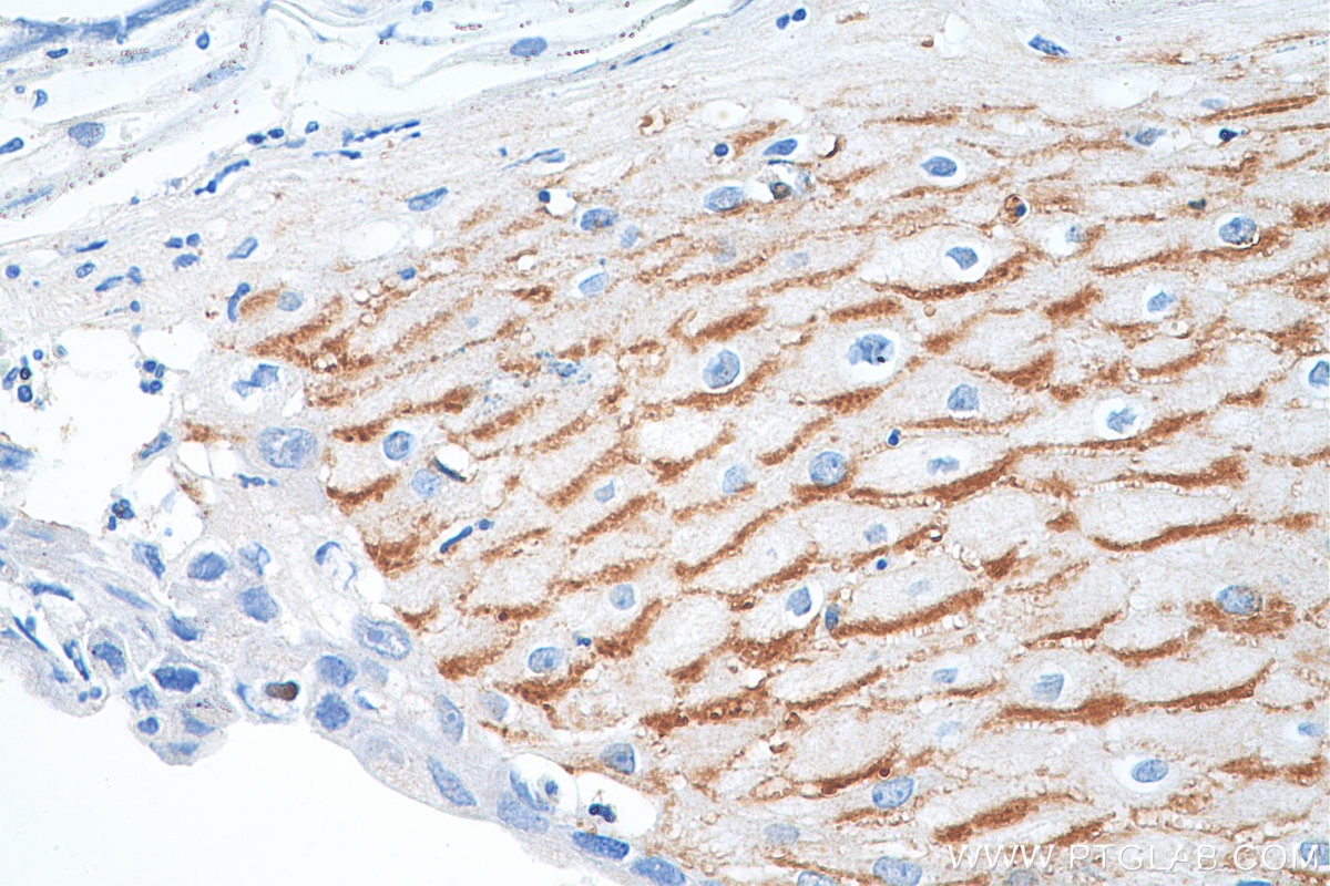 IHC staining of human skin cancer using 17361-1-AP