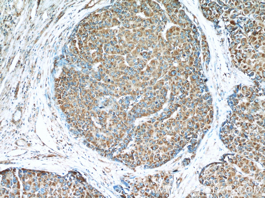 Immunohistochemistry (IHC) staining of human liver cancer tissue using LY6E Polyclonal antibody (22144-1-AP)