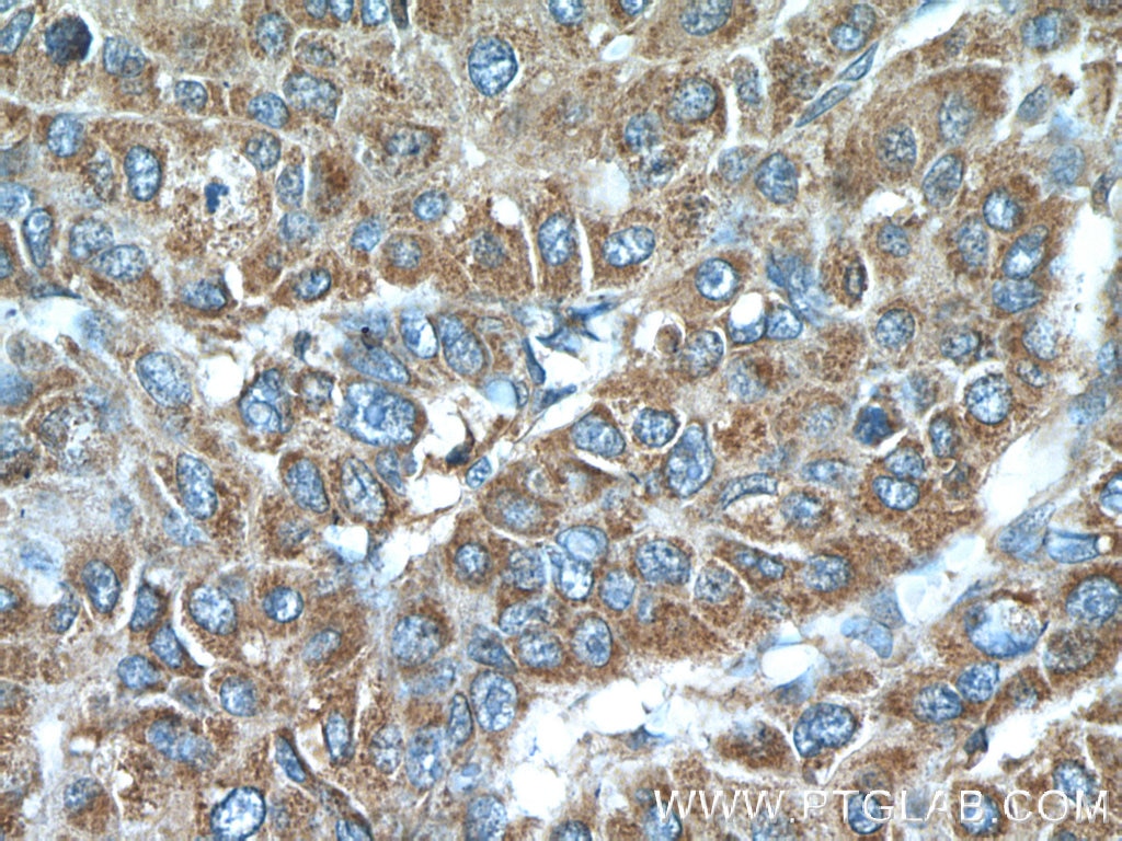 Immunohistochemistry (IHC) staining of human liver cancer tissue using LY6E Polyclonal antibody (22144-1-AP)
