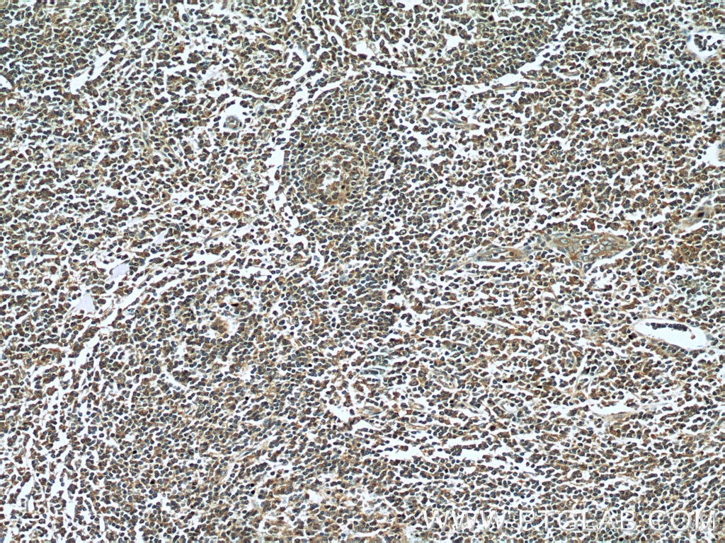 Immunohistochemistry (IHC) staining of human tonsillitis tissue using LY6E Polyclonal antibody (22144-1-AP)
