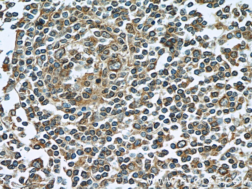 IHC staining of human tonsillitis using 22144-1-AP