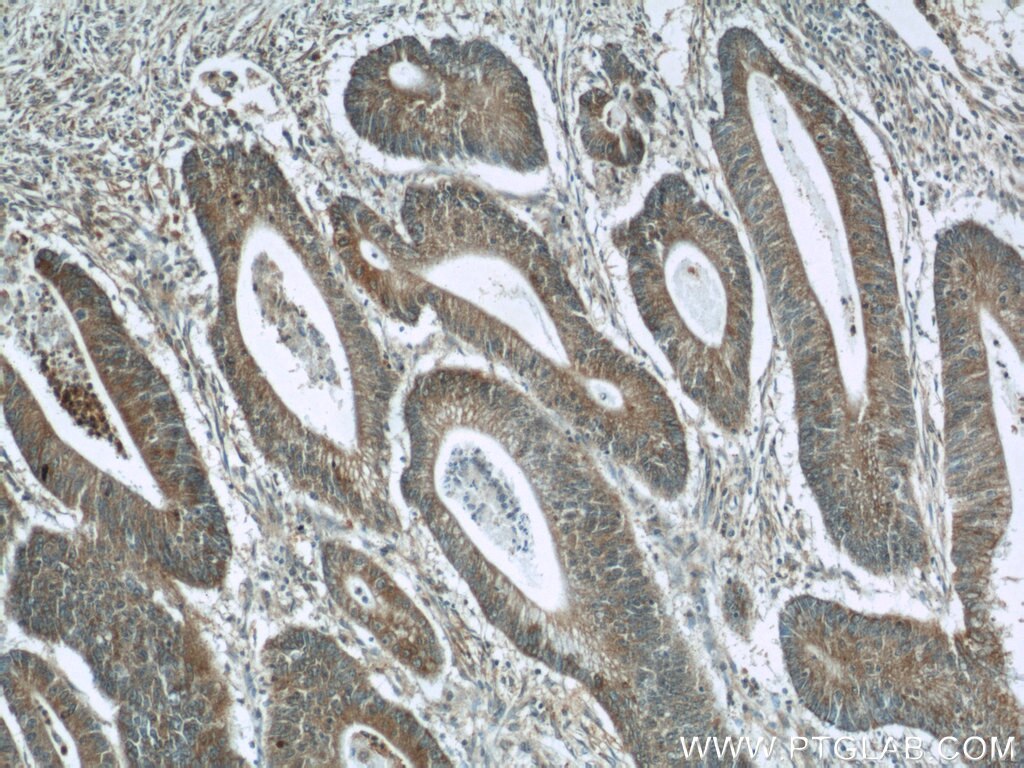 Immunohistochemistry (IHC) staining of human colon cancer tissue using LY6G5B Polyclonal antibody (24611-1-AP)