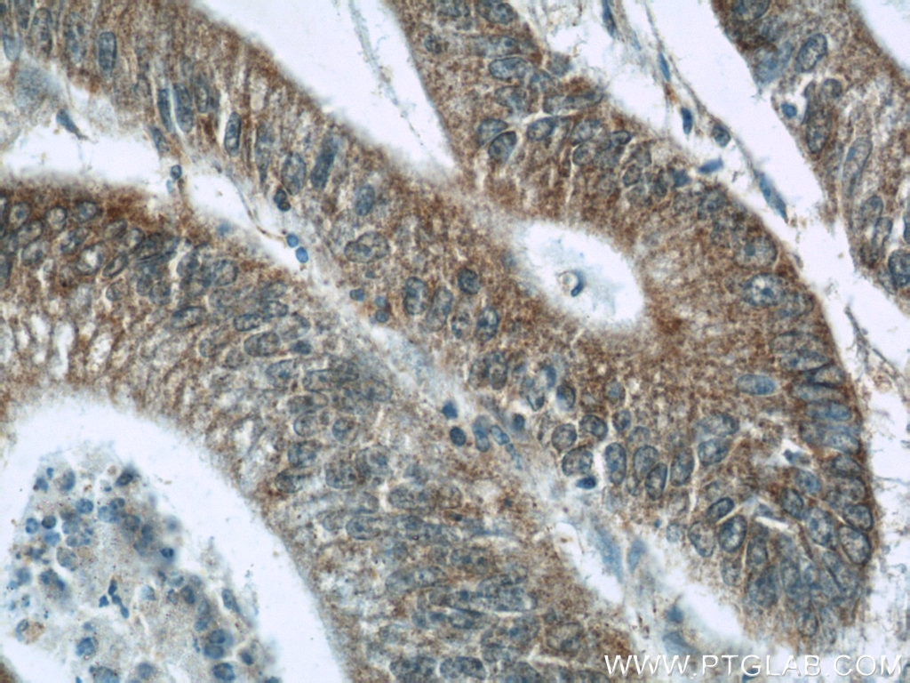 Immunohistochemistry (IHC) staining of human colon cancer tissue using LY6G5B Polyclonal antibody (24611-1-AP)