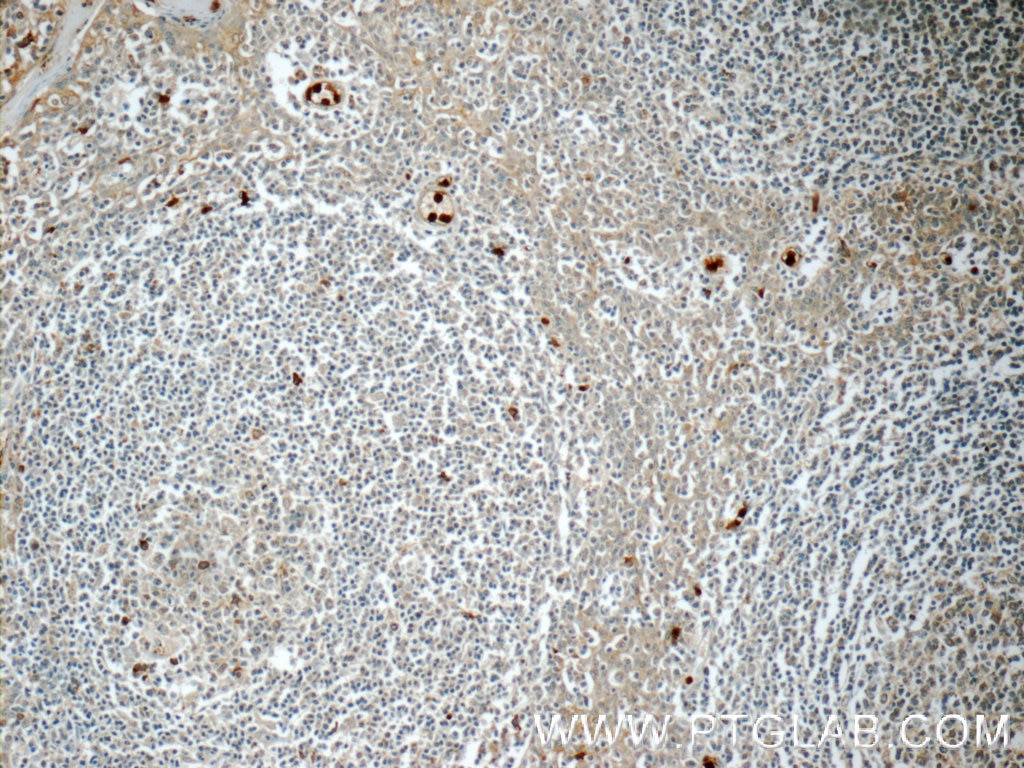 IHC staining of human tonsillitis using 24611-1-AP