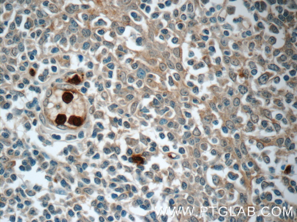 Immunohistochemistry (IHC) staining of human tonsillitis tissue using LY6G5B Polyclonal antibody (24611-1-AP)