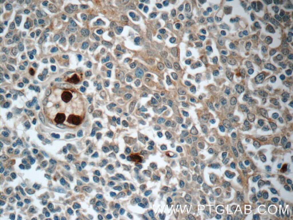 IHC staining of human tonsillitis using 24611-1-AP