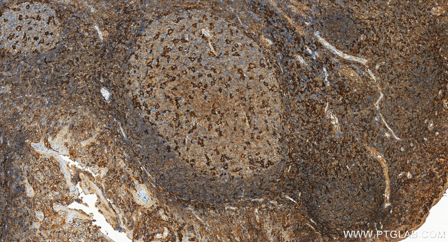 Immunohistochemistry (IHC) staining of human tonsillitis tissue using LY75/DEC-205 Polyclonal antibody (32754-1-AP)
