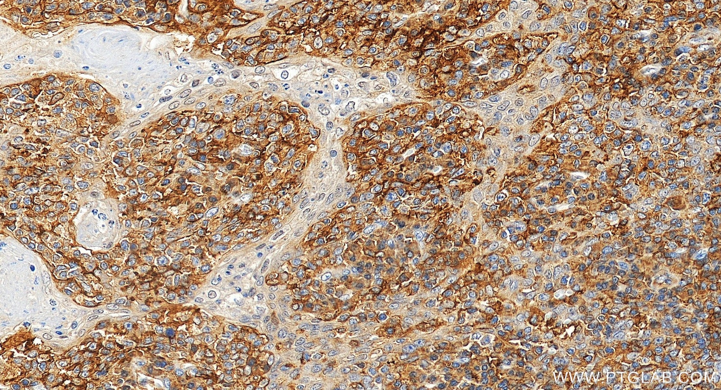 Immunohistochemical analysis of paraffin-embedded human tonsillitis tissue slide using 32754-1-AP (LY75/DEC-205 antibody) at dilution of 1:500 (under 20x lens). Heat mediated antigen retrieval with Tris-EDTA buffer (pH 9.0). Immunohistochemistry (IHC) staining of human tonsillitis tissue using LY75/DEC-205 Polyclonal antibody (32754-1-AP)