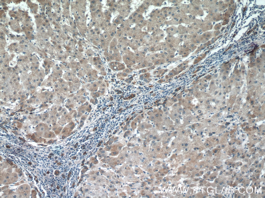 Immunohistochemistry (IHC) staining of human hepatocirrhosis tissue using LYN Polyclonal antibody (18135-1-AP)