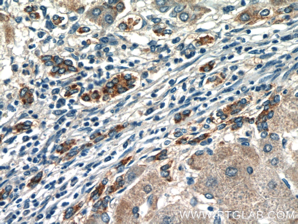 Immunohistochemistry (IHC) staining of human hepatocirrhosis tissue using LYN Polyclonal antibody (18135-1-AP)