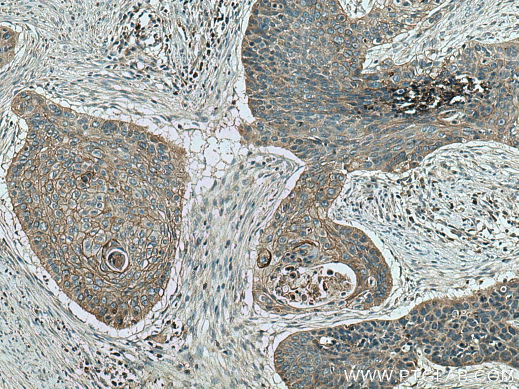 Immunohistochemistry (IHC) staining of human oesophagus cancer tissue using LYNX1 Polyclonal antibody (13373-1-AP)