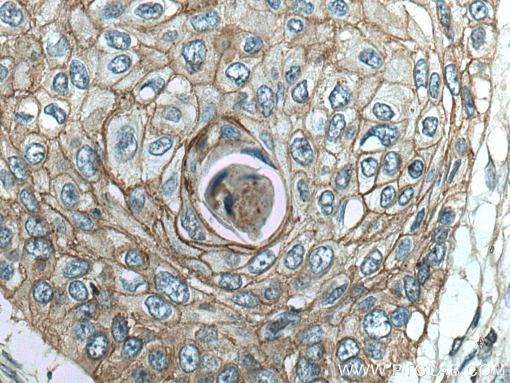 Immunohistochemistry (IHC) staining of human oesophagus cancer tissue using LYNX1 Polyclonal antibody (13373-1-AP)