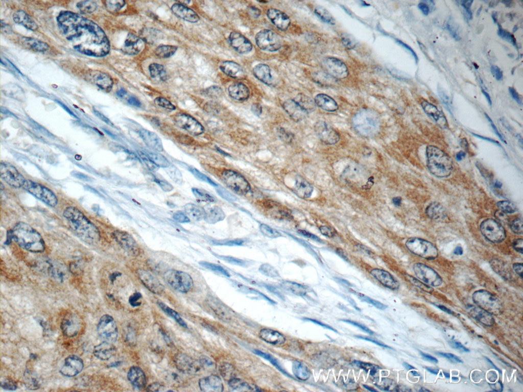 Immunohistochemistry (IHC) staining of human oesophagus cancer tissue using LYNX1 Polyclonal antibody (13373-1-AP)